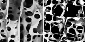 Microscopic view comparing normal bone structure (a) with osteoporotic bone structure (b).