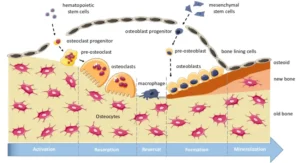 Diagram illustrating the bone remodeling process, showing osteoclasts breaking down bone and osteoblasts building new bone.